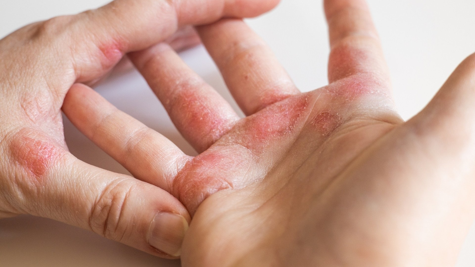 Viêm da cơ địa khiến lòng bàn tay nổi mụn nước, da khô, ngứa và dễ tái phát