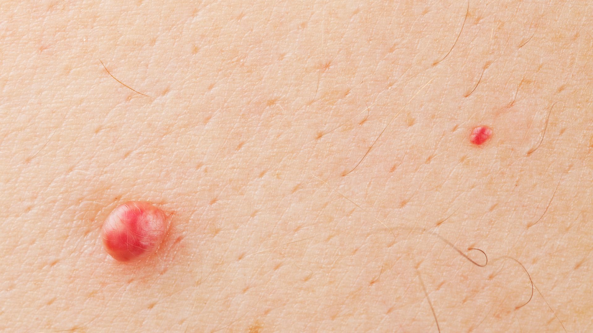 Viêm nang lông có thể là nguyên nhân gây nổi mụn ở môi bé vùng kín