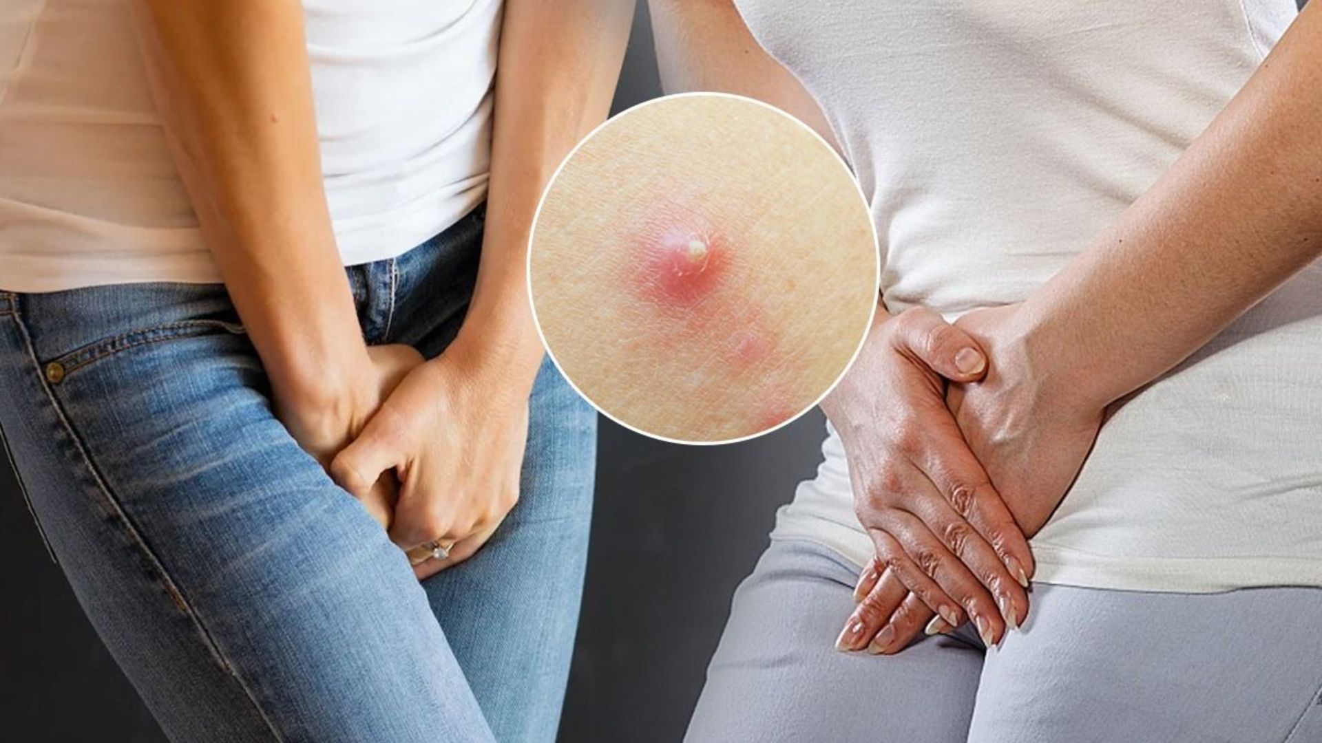 Mụn đỏ, mụn nước hoặc mụn mủ xuất hiện ở môi bé