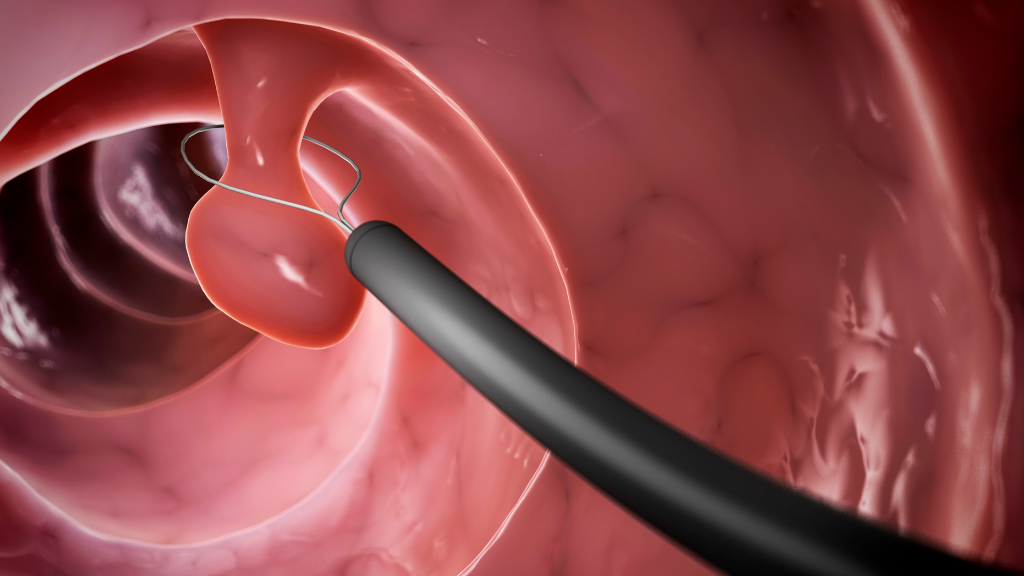 Nội soi gây mê: Giải pháp thăm khám tiêu hóa an toàn và nhẹ nhàng 2