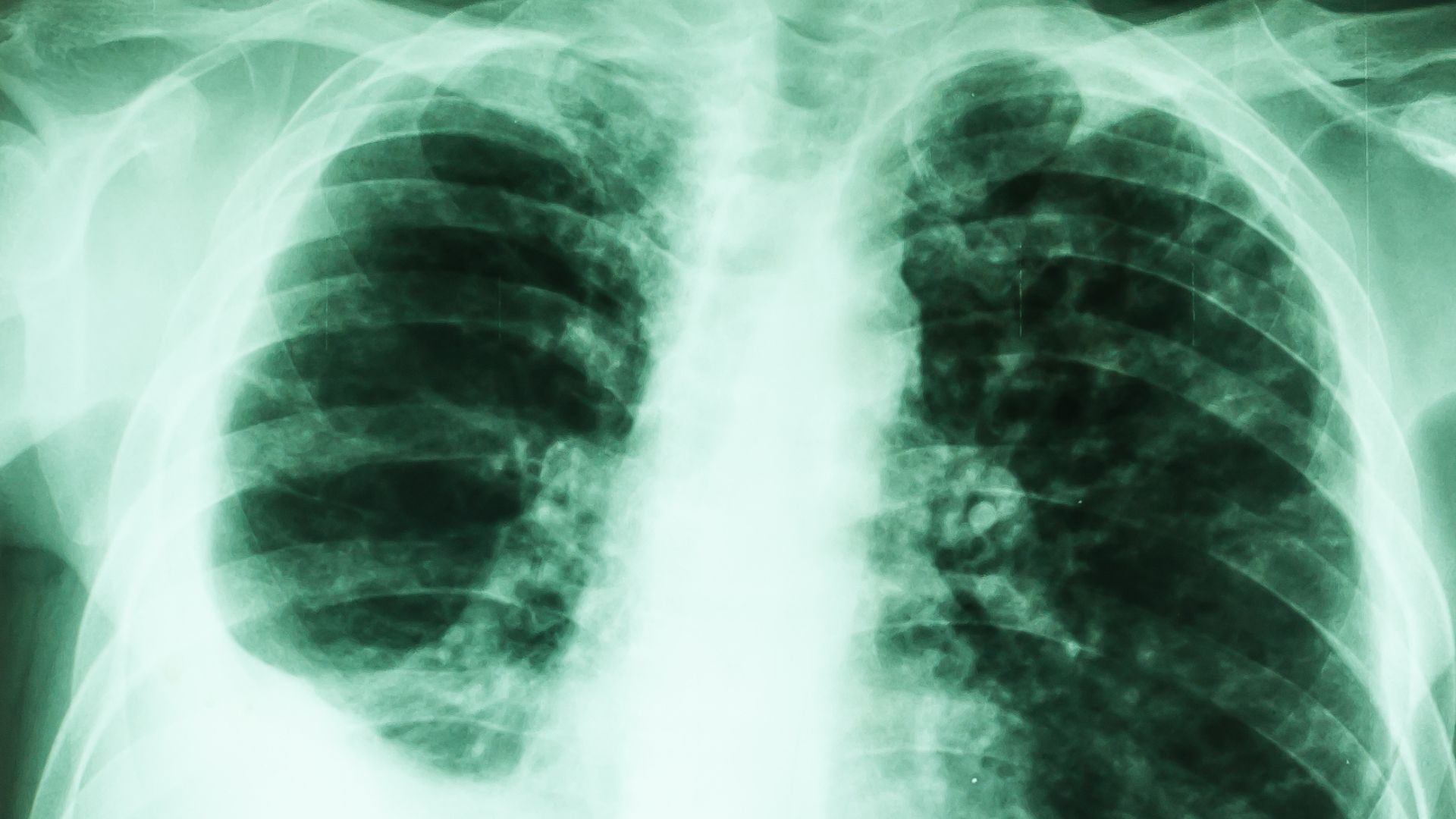 Nội soi màng phổi giúp quan sát trực tiếp tổn thương và lấy sinh thiết chính xác