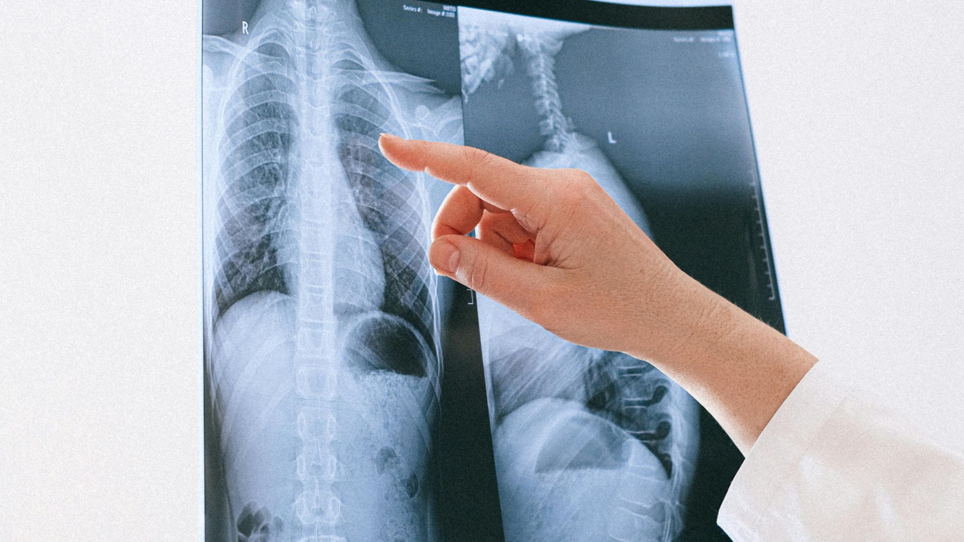 Quy trình nội soi màng phổi được thực hiện trong điều kiện vô khuẩn và kiểm soát nghiêm ngặt