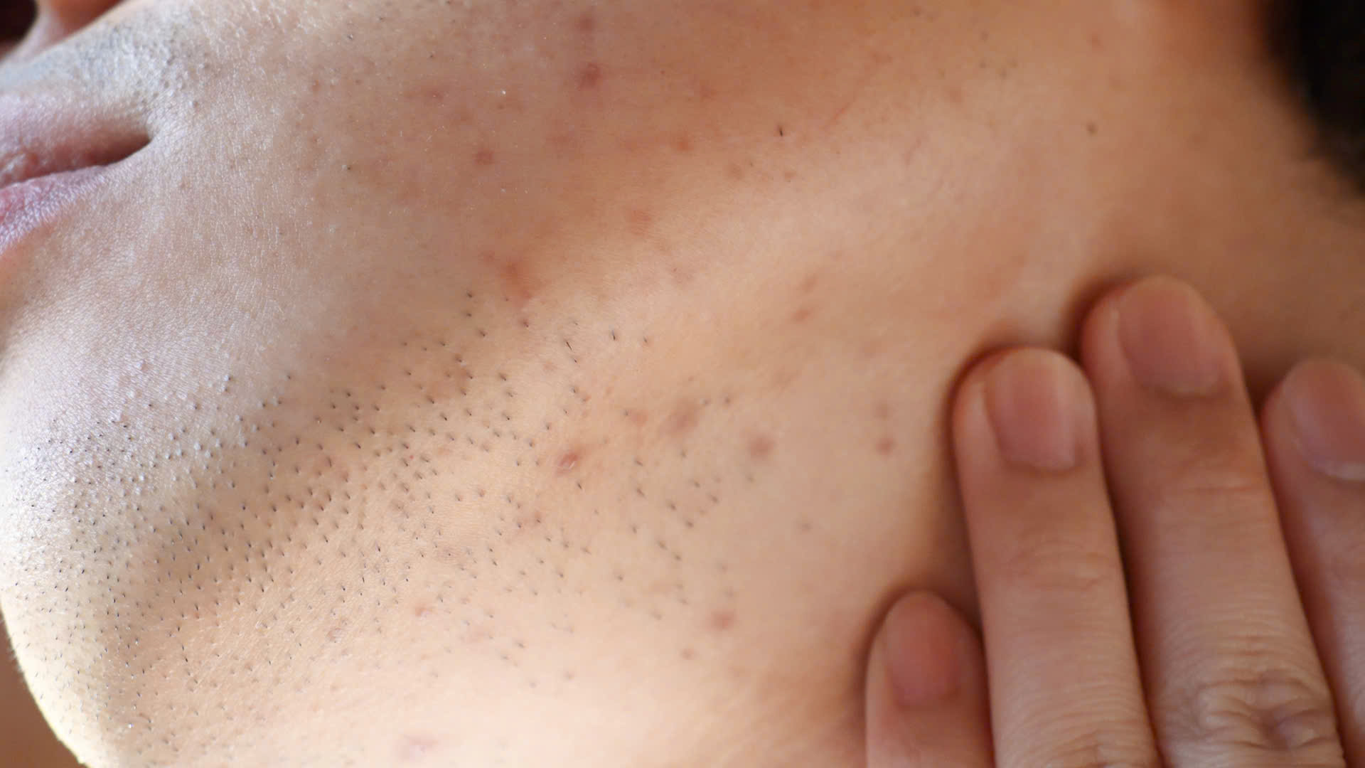 Nọng cằm có thể xuất hiện do nhiều yếu tố liên quan đến cơ địa và lối sống