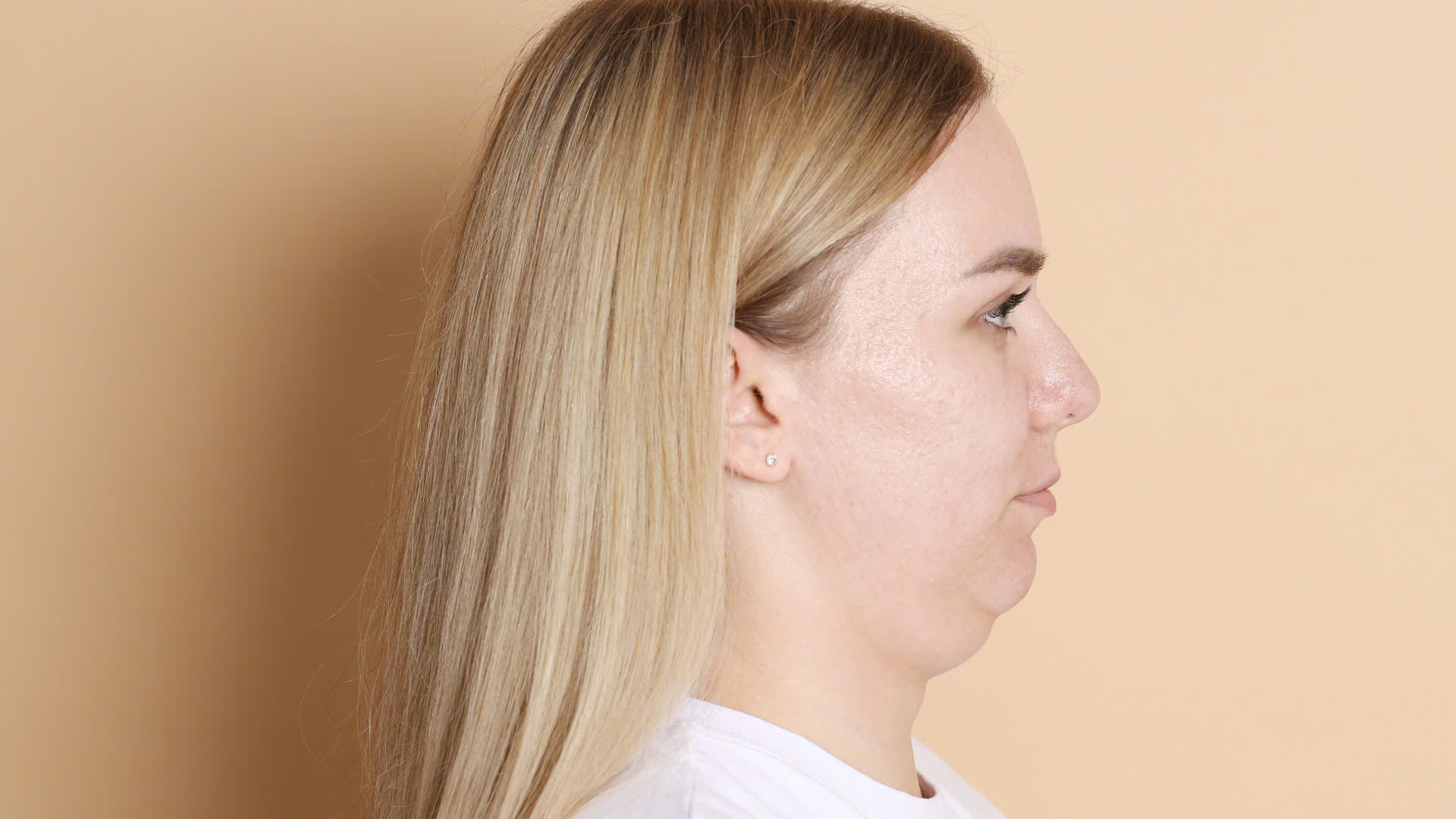 Nọng cằm chủ yếu liên quan đến sự tích tụ mỡ ở vùng dưới cằm