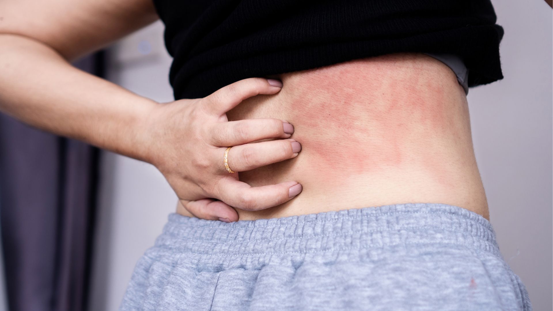Nóng gan nổi mề đay: Tìm hiểu nguyên nhân và hướng điều trị khoa học, an toàn 1
