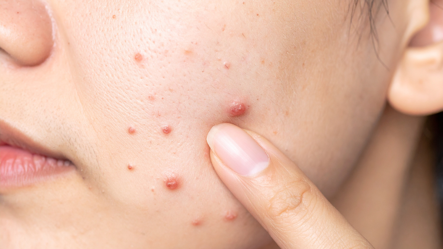 Bạn nên đi khám bác sĩ khi tình trạng mụn kéo dài, lan rộng, viêm đau nhiều hoặc không cải thiện