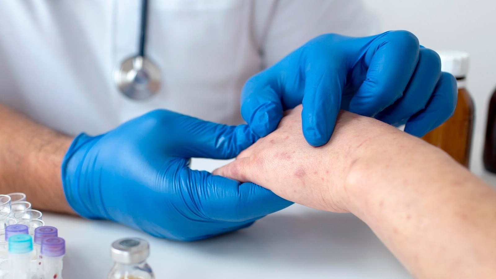 Khi các nốt mủ đã lành, người bệnh có thể thực hiện các phương pháp phục hồi da và ngừa sẹo sau thủy đậu