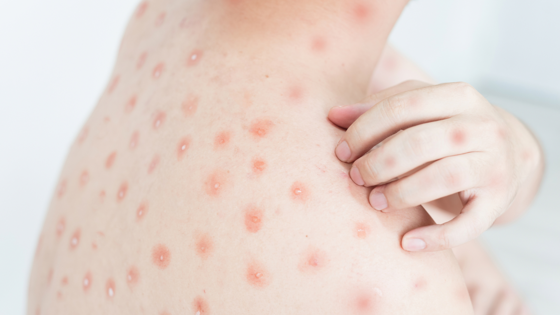 Nốt thủy đậu mưng mủ trắng là dấu hiệu nhiễm trùng da