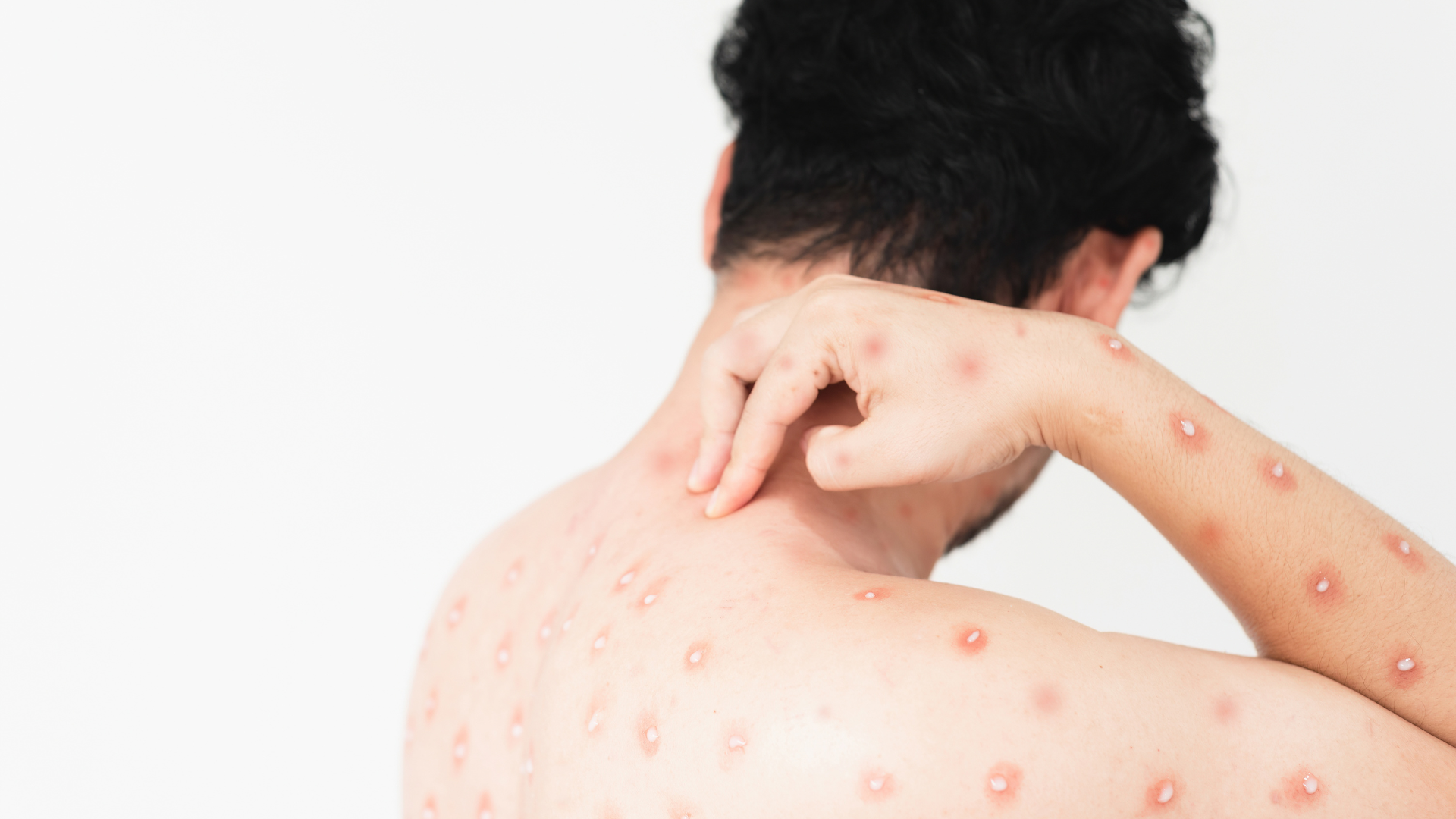 Việc nặn mủ có thể làm vi khuẩn lan rộng và tăng nguy cơ nhiễm trùng