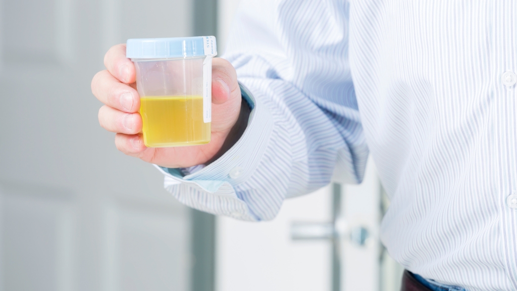 Quy trình lấy mẫu nước tiểu đúng cách giúp đảm bảo kết quả xét nghiệm chính xác