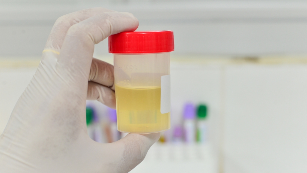 Một số lưu ý quan trọng giúp lấy mẫu nước tiểu xét nghiệm chính xác và đáng tin cậy