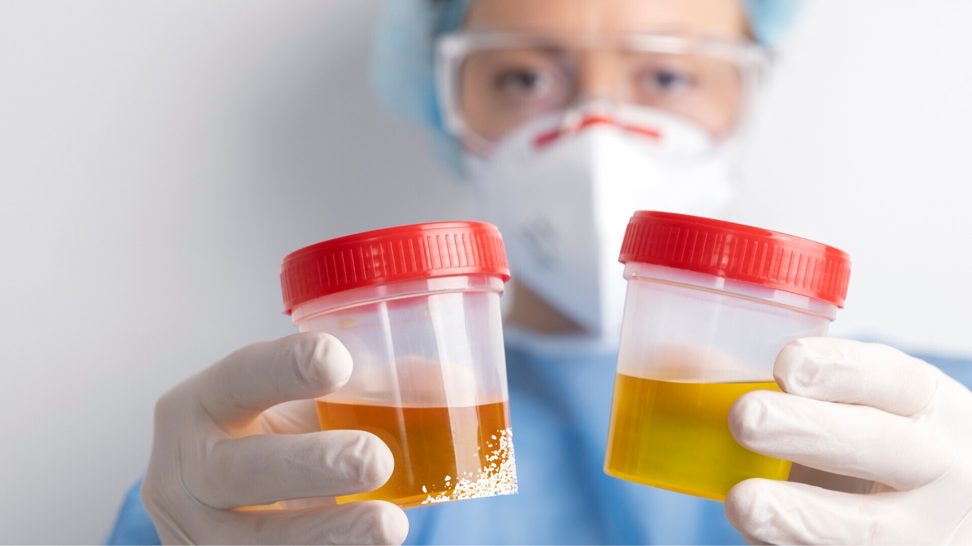 Không nên chủ quan trước tình trạng nước tiểu đục có cặn trắng