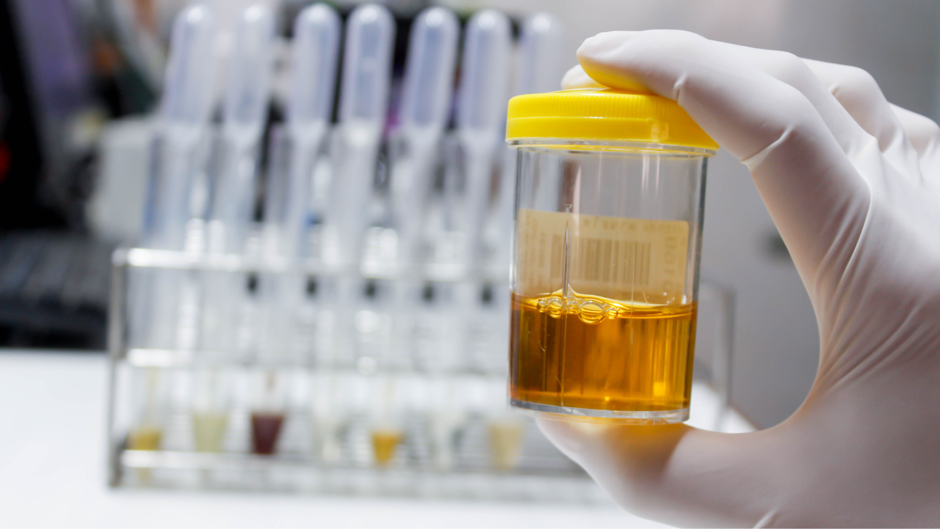 Màu sắc nước tiểu khi mang thai phản ánh tình hình sức khỏe của mẹ bầu