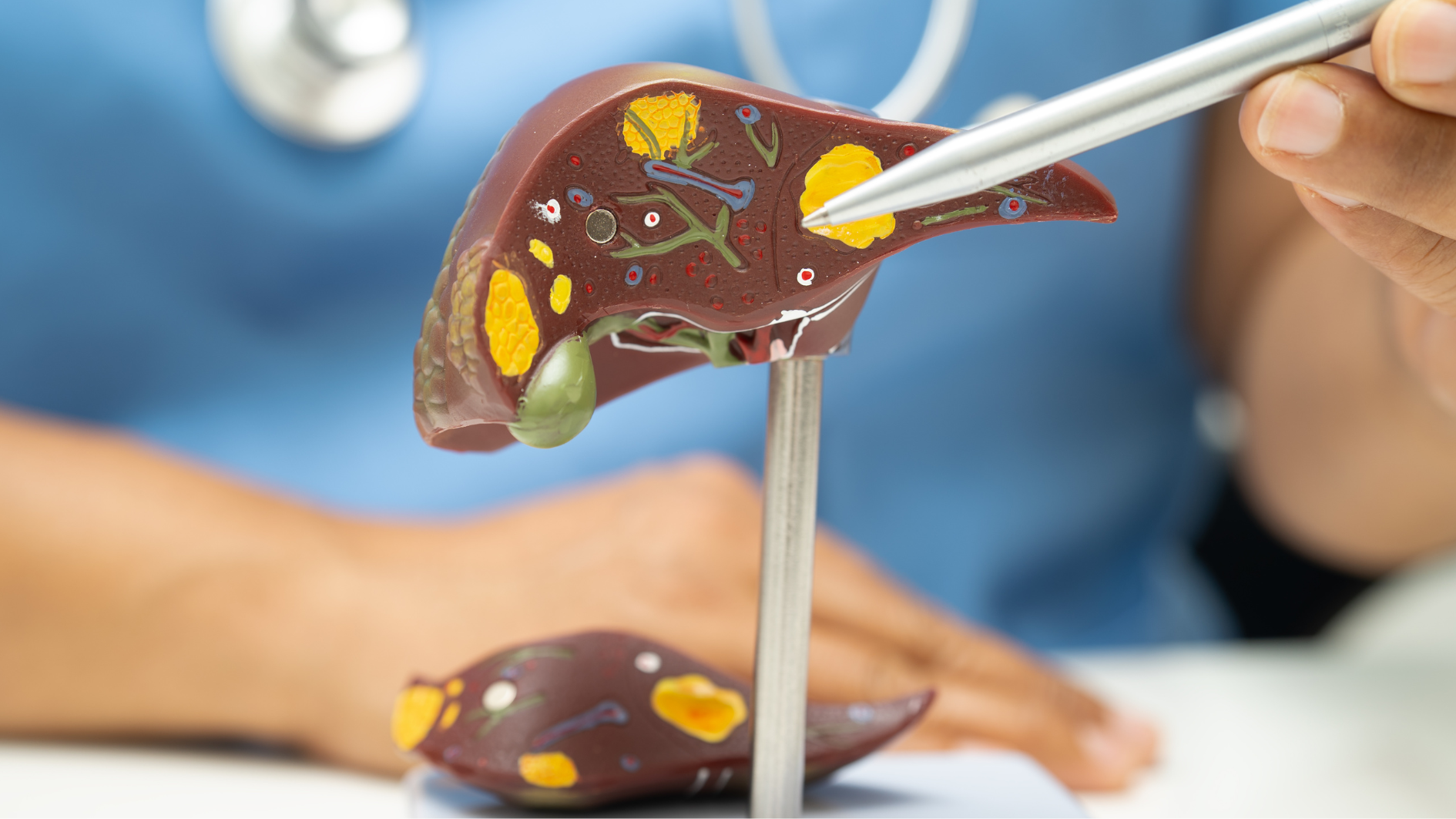 Các vấn đề về gan thường gây nước tiểu sẫm màu