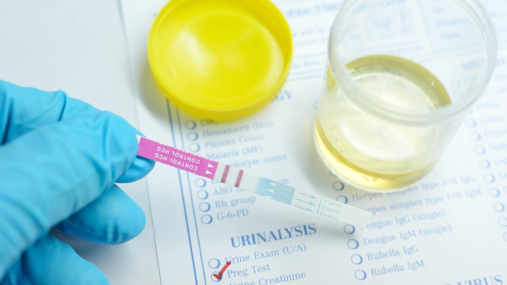 Nước tiểu trong suốt có thể bình thường hoặc cảnh báo bệnh lý tiềm ẩn