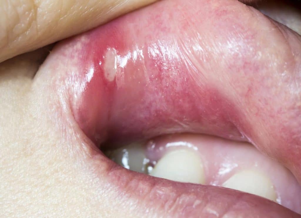 Nuốt tinh trùng có bị HIV không? Cách phòng ngừa HIV và các bệnh lây truyền qua đường tình dục 4