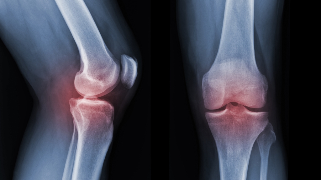 Chụp X-quang hoặc CT scan giúp chẩn đoán chính xác tình trạng nứt xương bánh chè