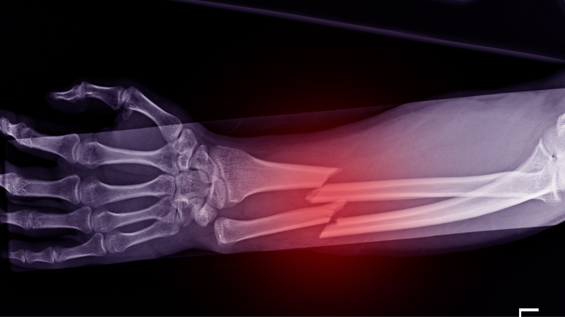 Nếu không được điều trị kịp thời, vết nứt xương có thể tiến triển thành gãy xương