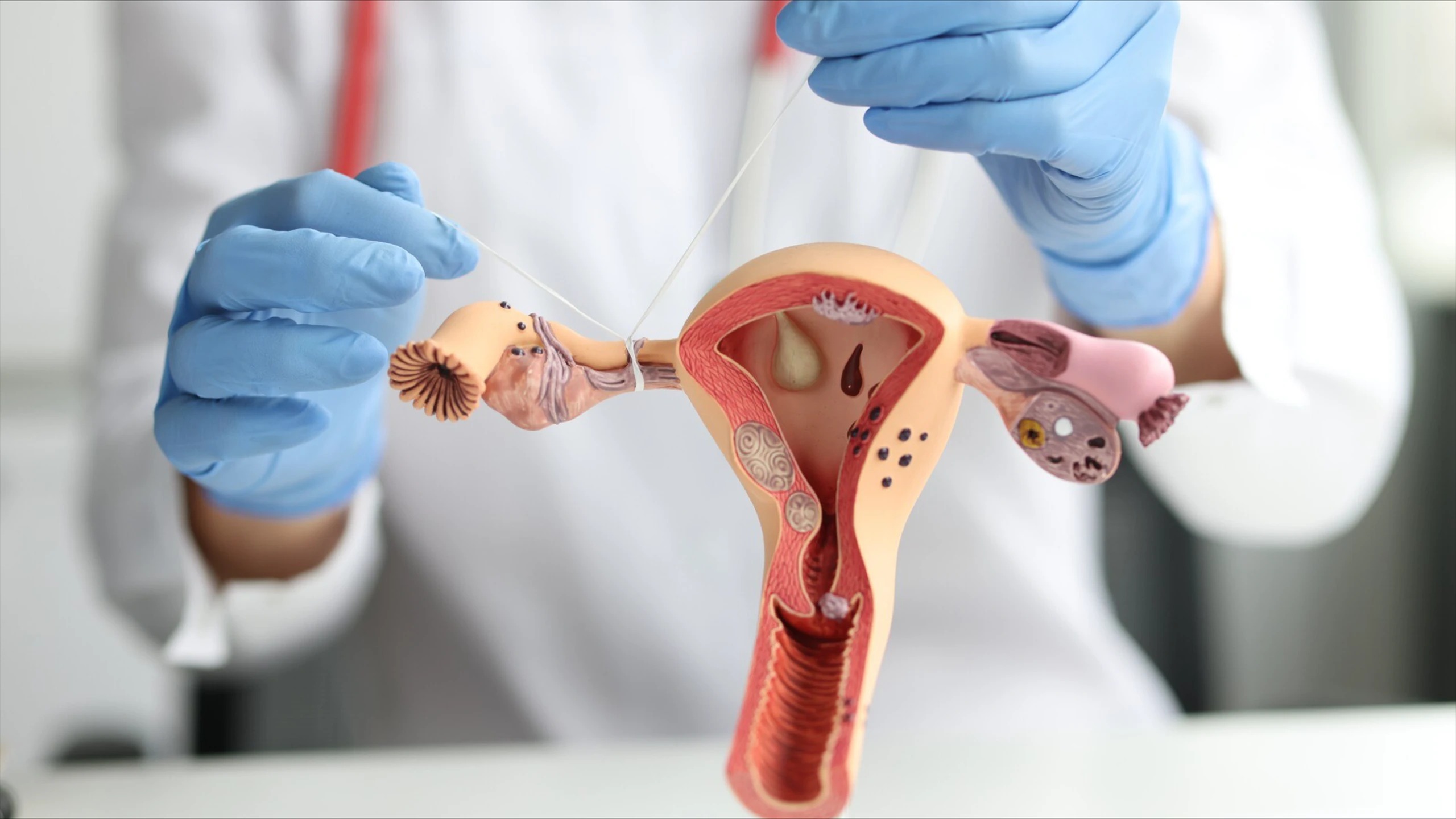 Viêm tắc vòi trứng gây đau bụng dưới, rối loạn kinh nguyệt và khó thụ thai