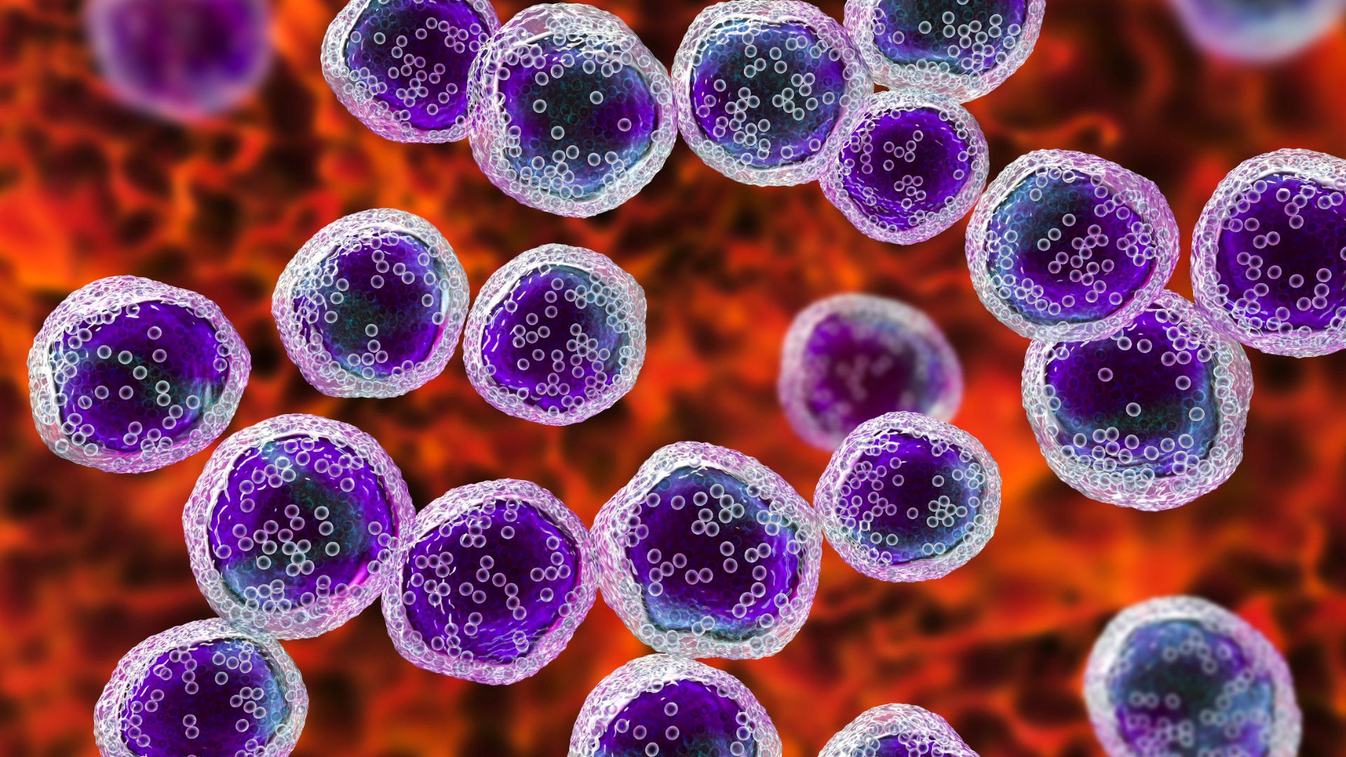 Paget vú là một dạng ung thư hiếm gặp do sự phát triển tế bào ác tính ở vùng núm vú