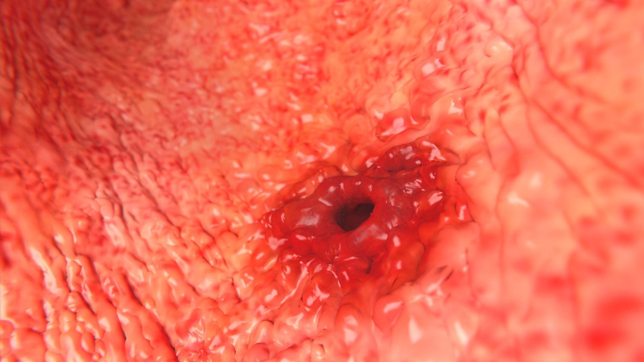 Loét dạ dày tá tràng có phải là bệnh nghiêm trọng?