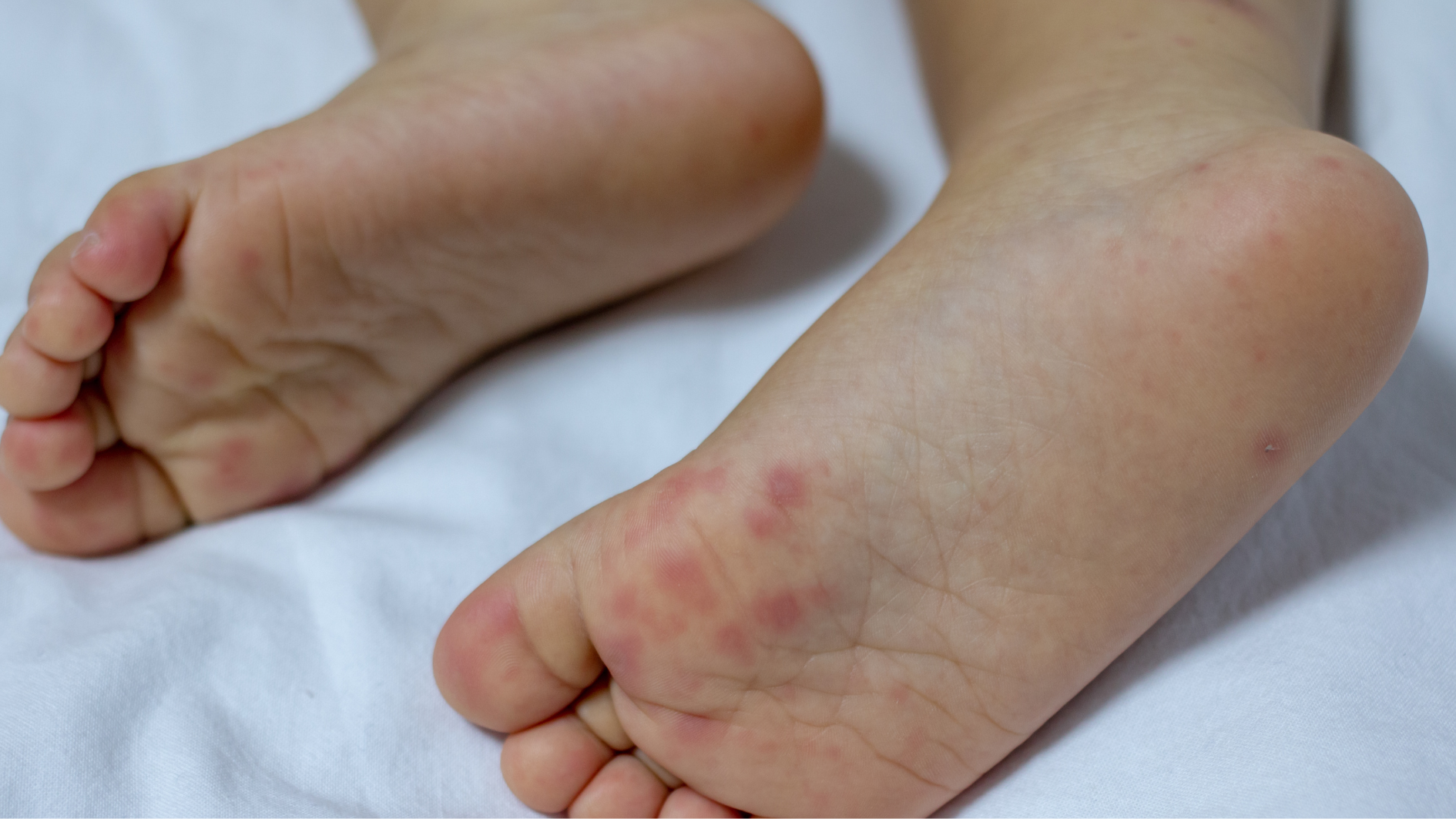 Tay chân miệng là một trong các loại phát ban thường gặp ở trẻ
