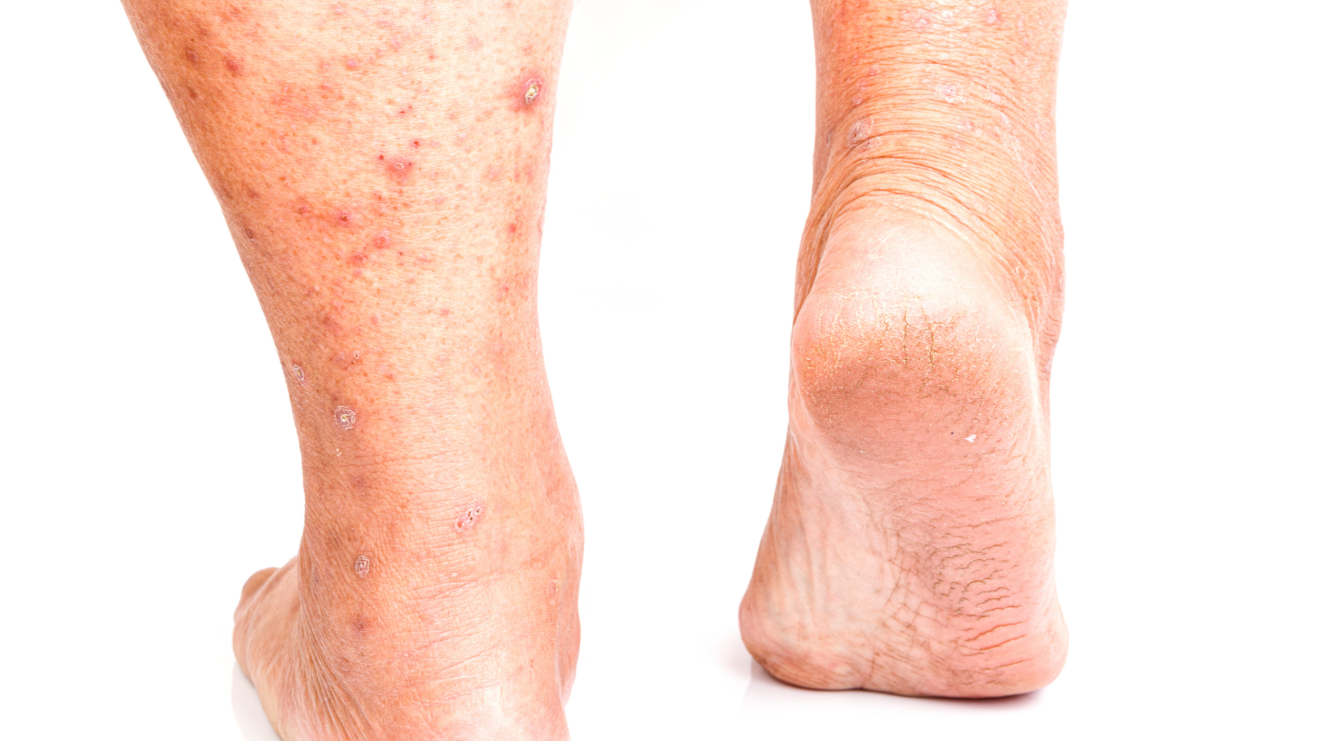 Một số trường hợp nhiễm HIV có thể xuất hiện phát ban đỏ và các nốt đỏ trên da