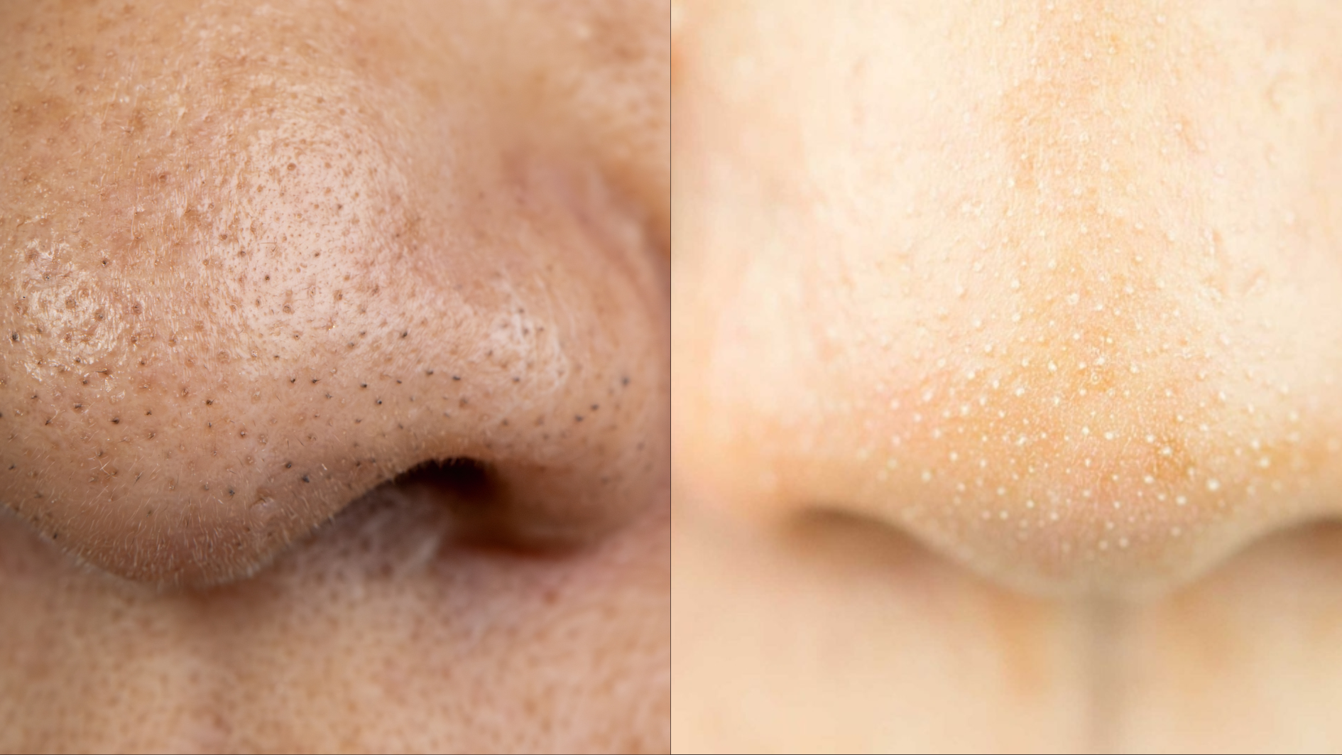 Mụn đầu đen và sợi bã nhờn là vấn đề da liễu phổ biến