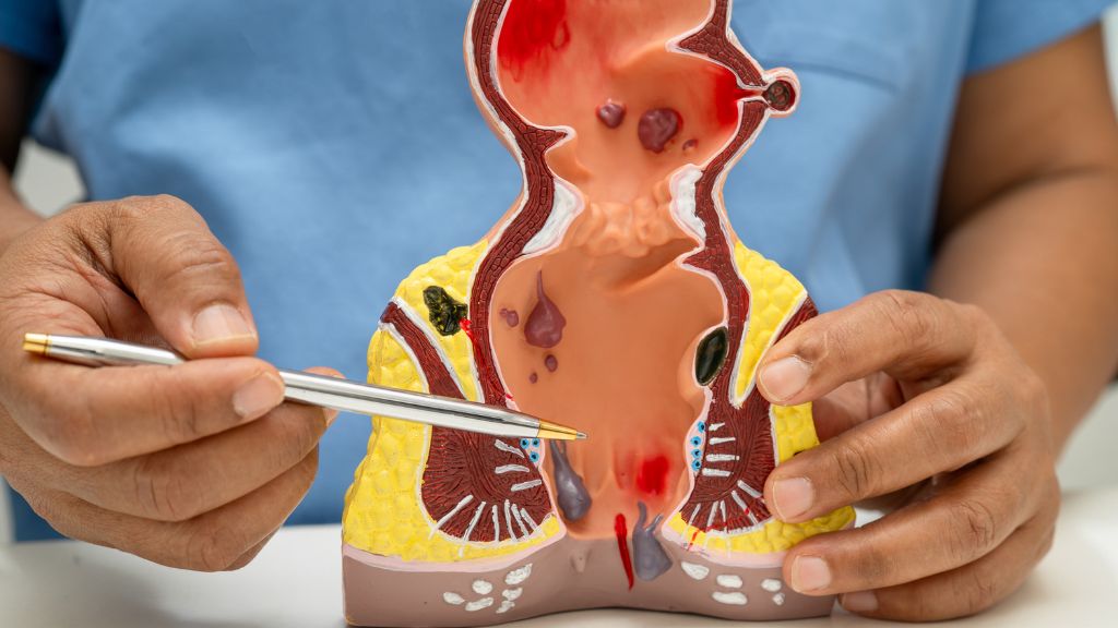 Theo các nghiên cứu, người bị trĩ có nguy cơ mắc ung thư đại trực tràng cao hơn người bình thường gần 3 lần