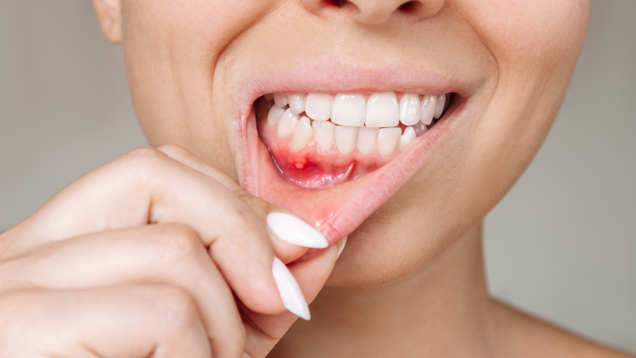 Phân biệt ung thư lưỡi và nhiệt miệng như thế nào?4