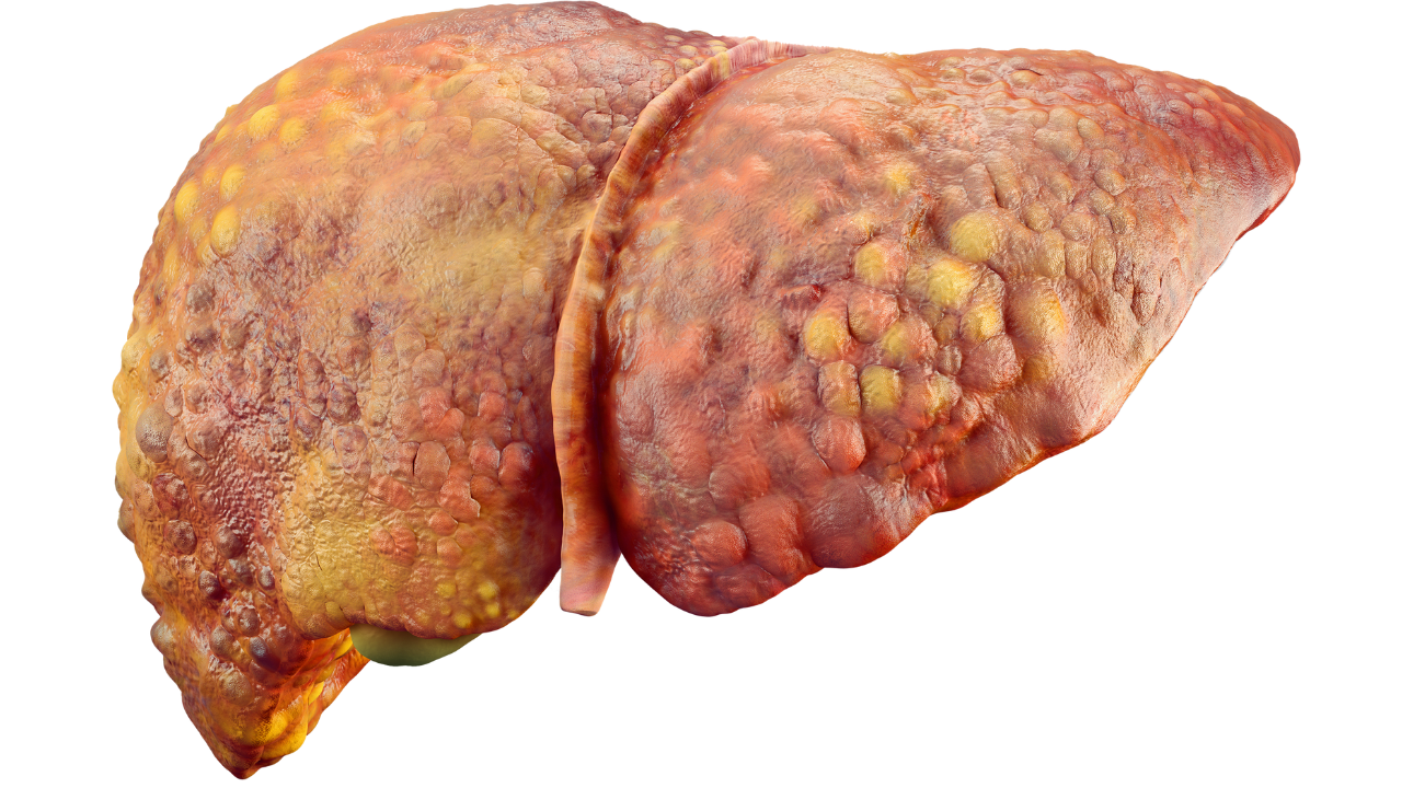 Child-Pugh C: Giai đoạn nặng, gan gần như mất chức năng