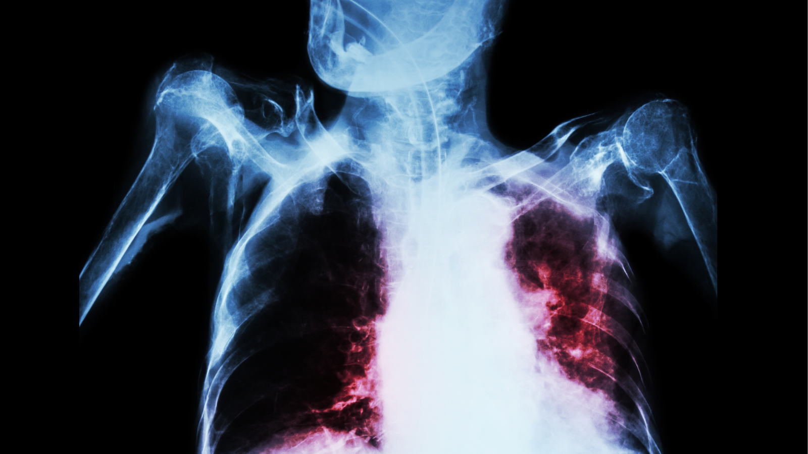 Dấu hiệu co kéo hõm ức và cơ hô hấp phụ ở trẻ suy hô hấp trung bình