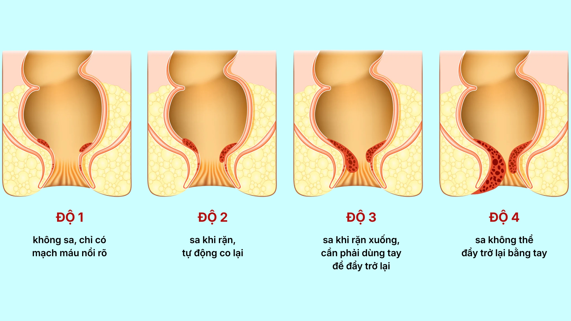 Phân độ trĩ nội theo 4 cấp độ