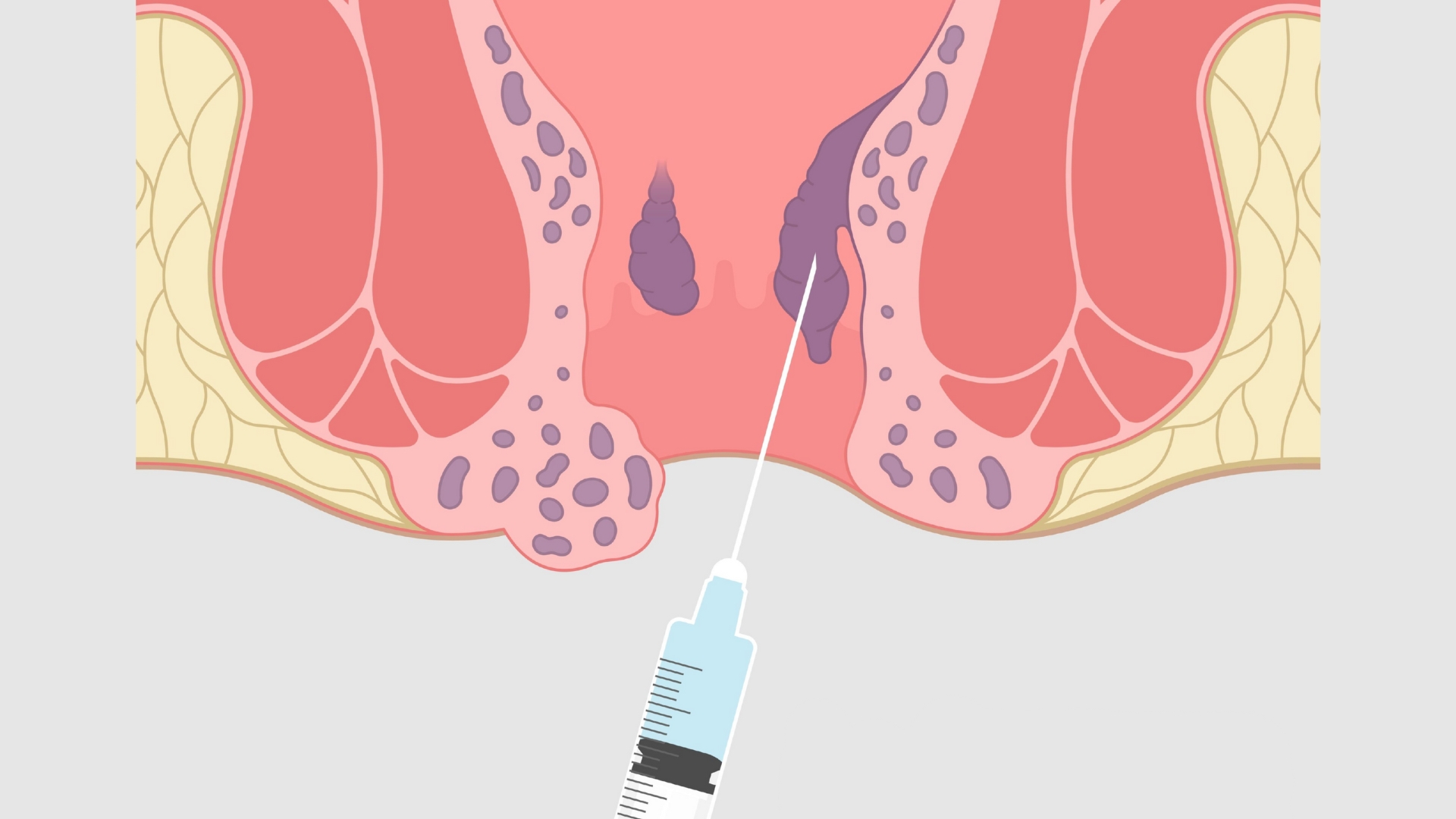 Chích xơ búi trĩ có thể được chỉ định để điều trị trĩ độ 2