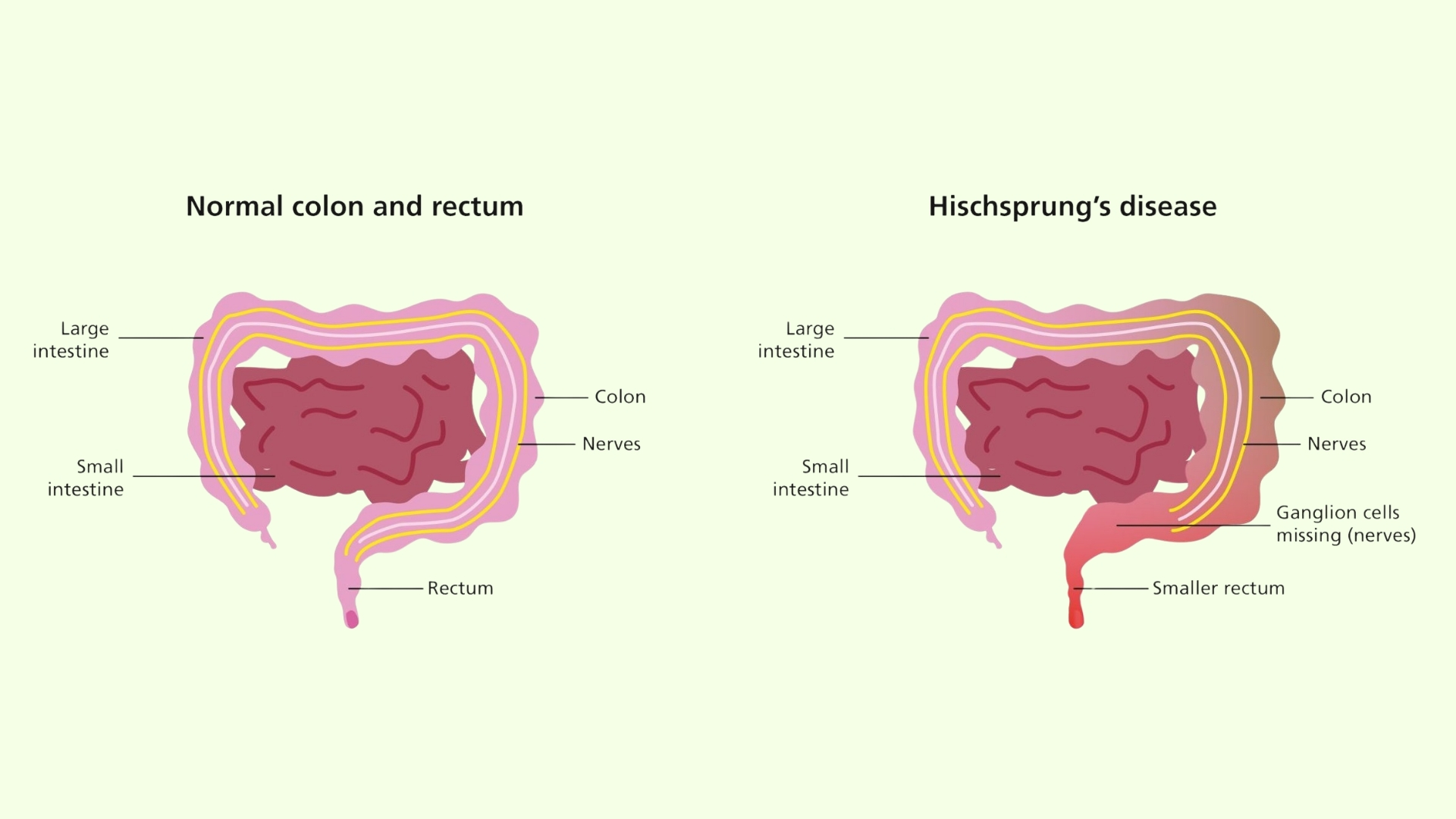 Hirschsprung là dị tật bẩm sinh do thiếu tế bào hạch thần kinh ở đoạn cuối ruột già, dẫn đến mất nhu động ruột và tắc nghẽn phân