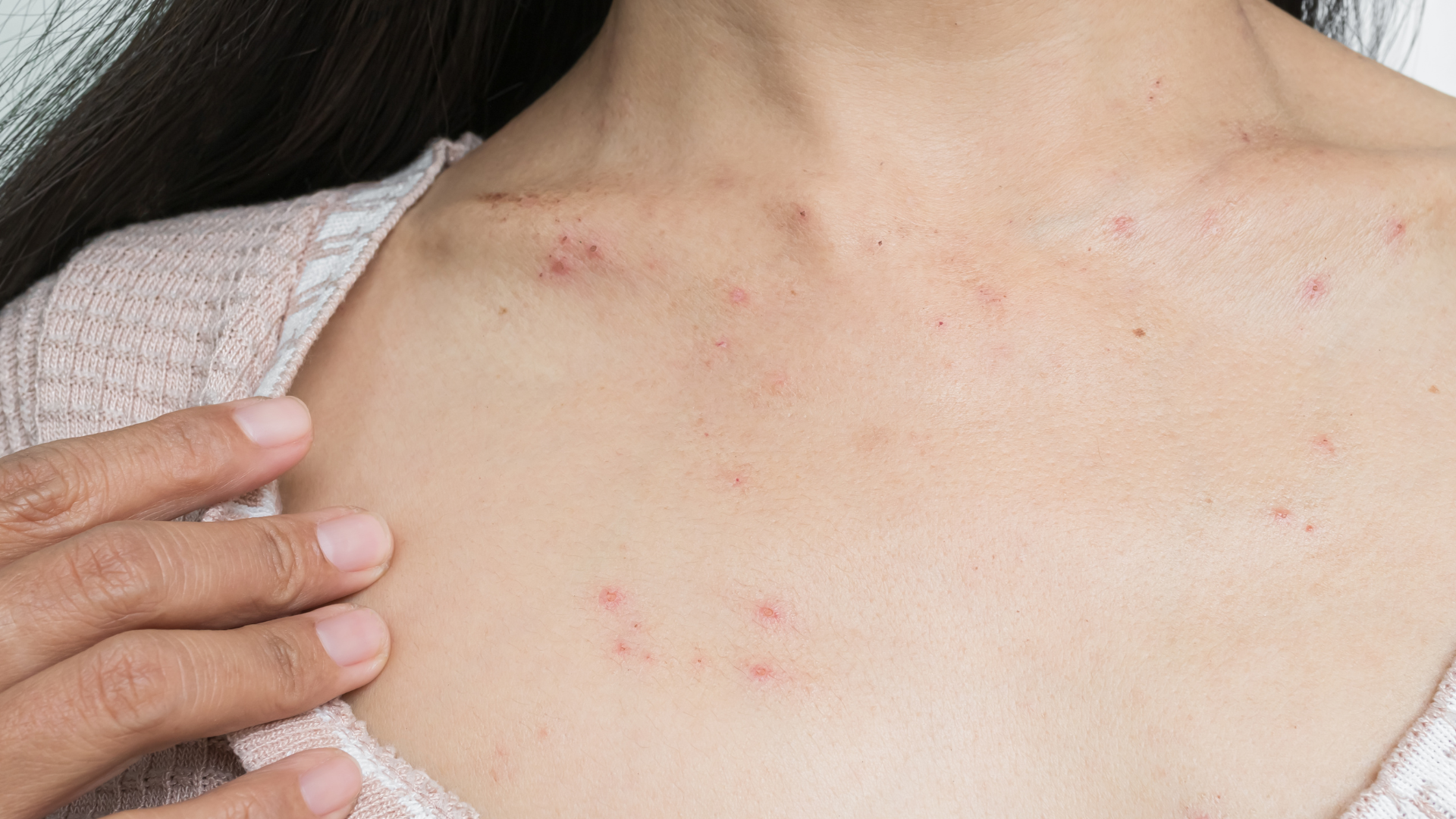 Nổi mẩn ngứa, sưng mặt hoặc khó thở cần đi khám ngay