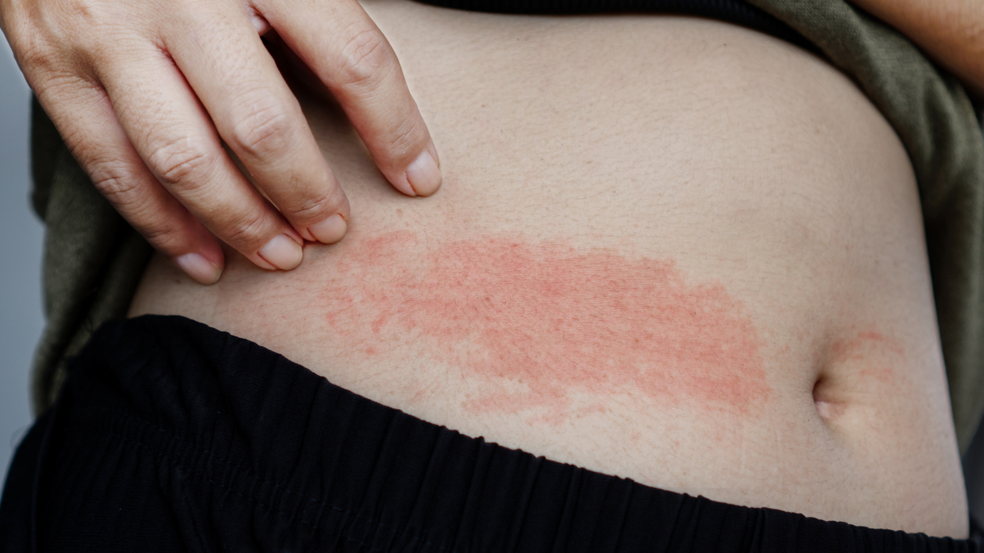 Hình thái phát ban giang mai thường gặp