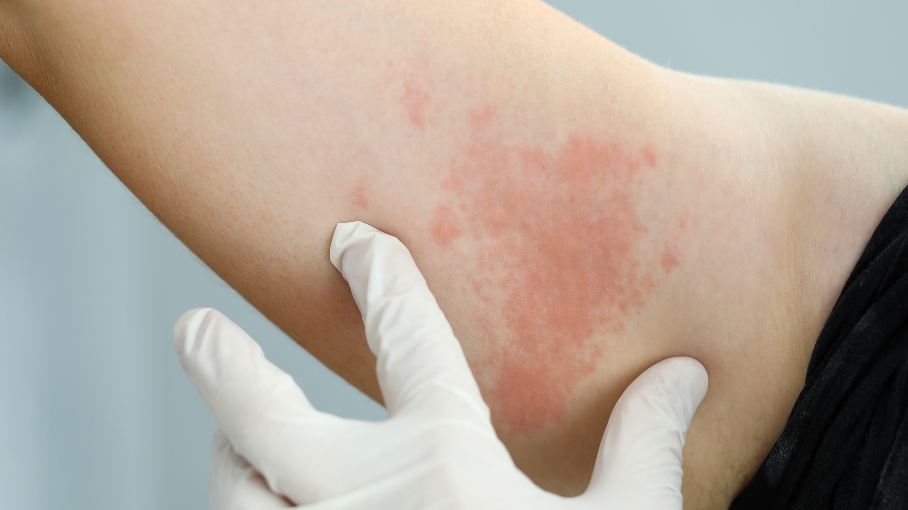 Phát ban HIV là gì? Dấu hiệu nhận biết và cách phân biệt với phát ban khác 1