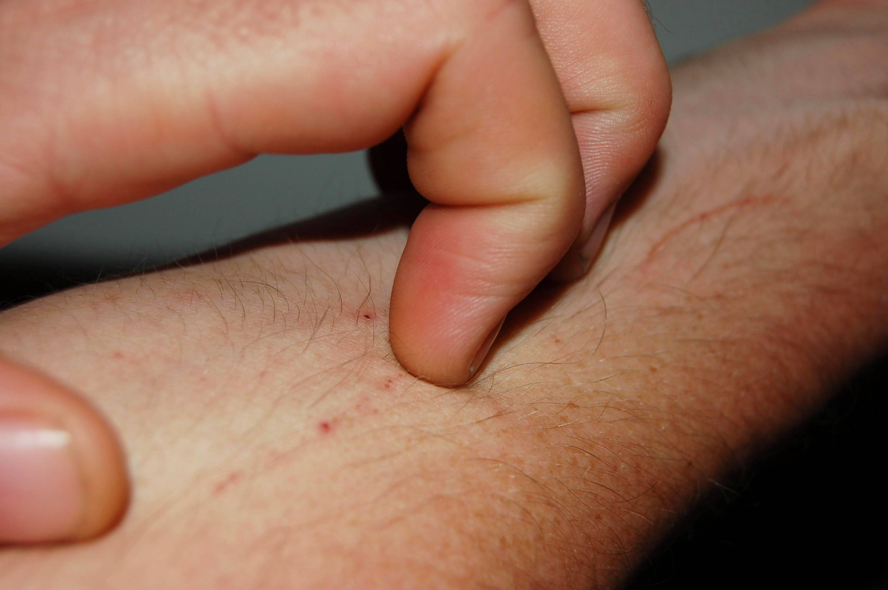 Phát ban HIV là gì? Dấu hiệu nhận biết và cách phân biệt với phát ban khác 2