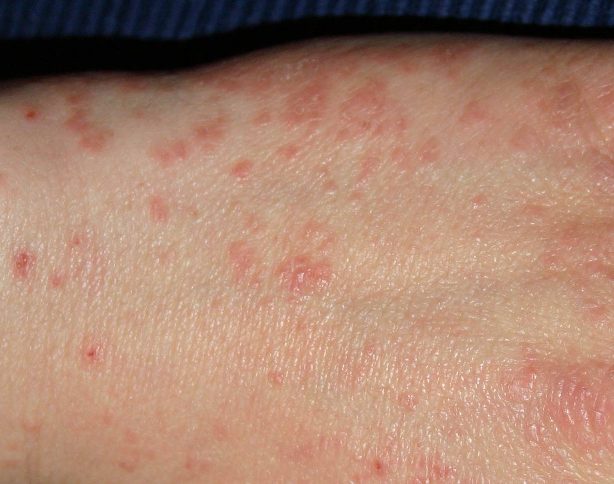 Phát ban HIV là gì? Dấu hiệu nhận biết và cách phân biệt với phát ban khác 3