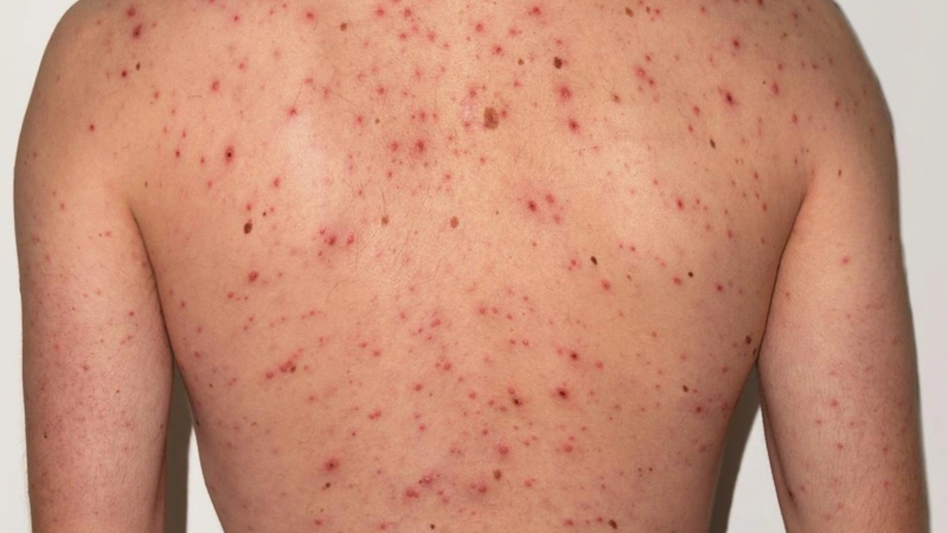 Khi phát ban xuất hiện kèm mụn trứng cá, da dễ ngứa rát và có tổn thương lan rộng