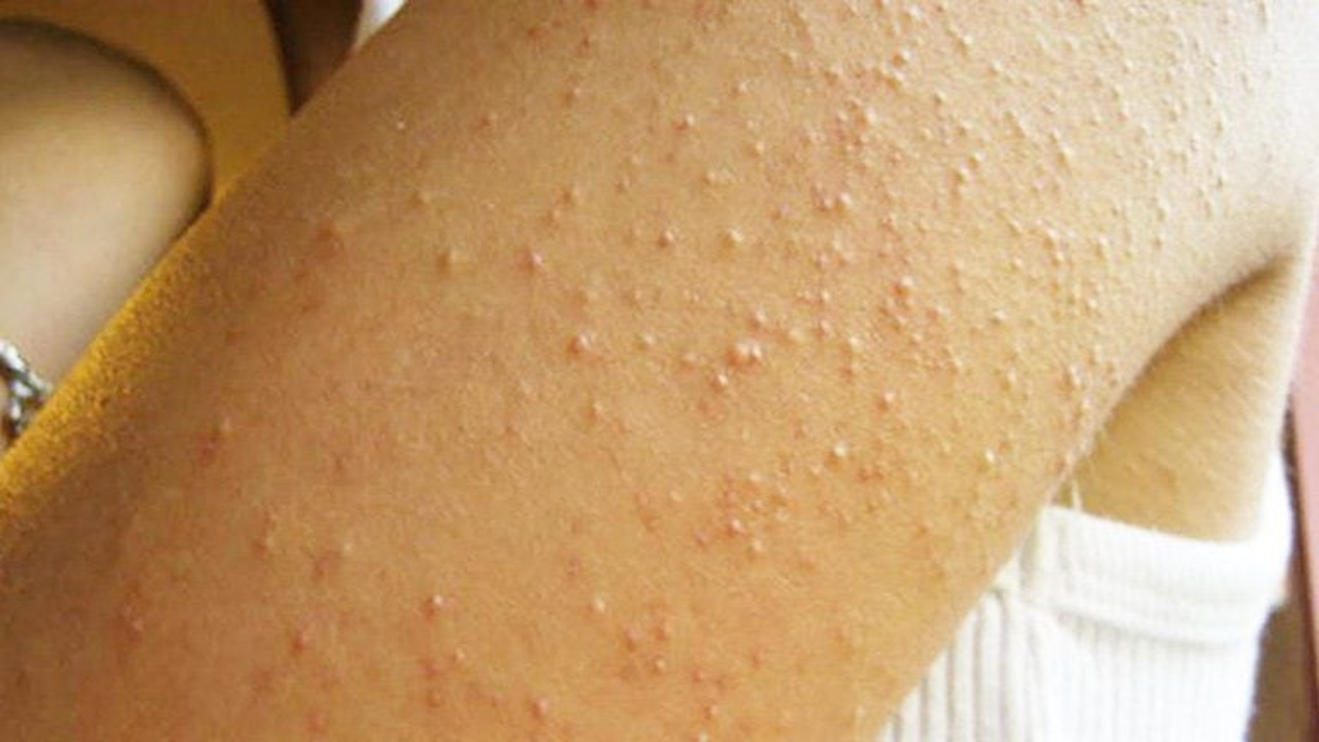 Khi bị phát ban mụn trứng cá, các biểu hiện dễ gặp gồm sẩn viêm, mụn mủ và mụn nang gây đau