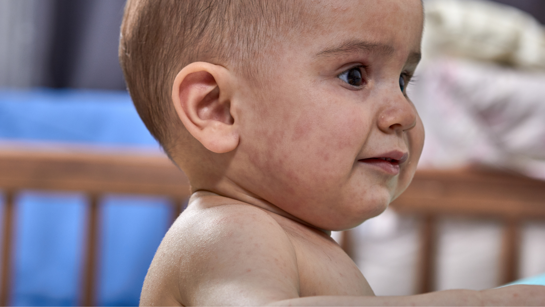 phat-ban-sau-sot-o-tre-co-nguy-hiem (2).png