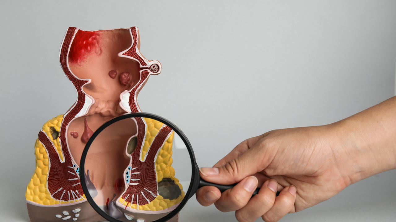 Vì sao cần phải phẫu thuật rò hậu môn?