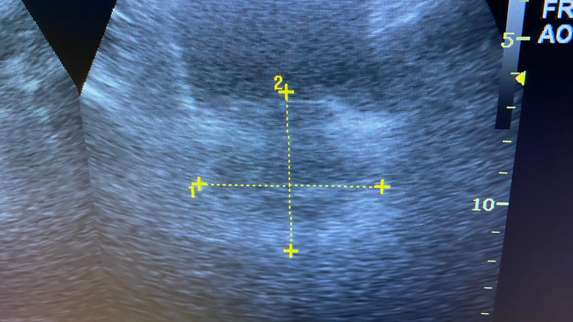 Phì đại tuyến tiền liệt: Nguyên nhân, triệu chứng và điều trị 5