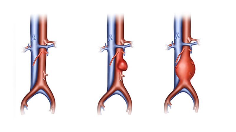 Phình động mạch chủ bụng làm thay đổi cấu trúc và đường kính của động mạch chủ trong ổ bụng