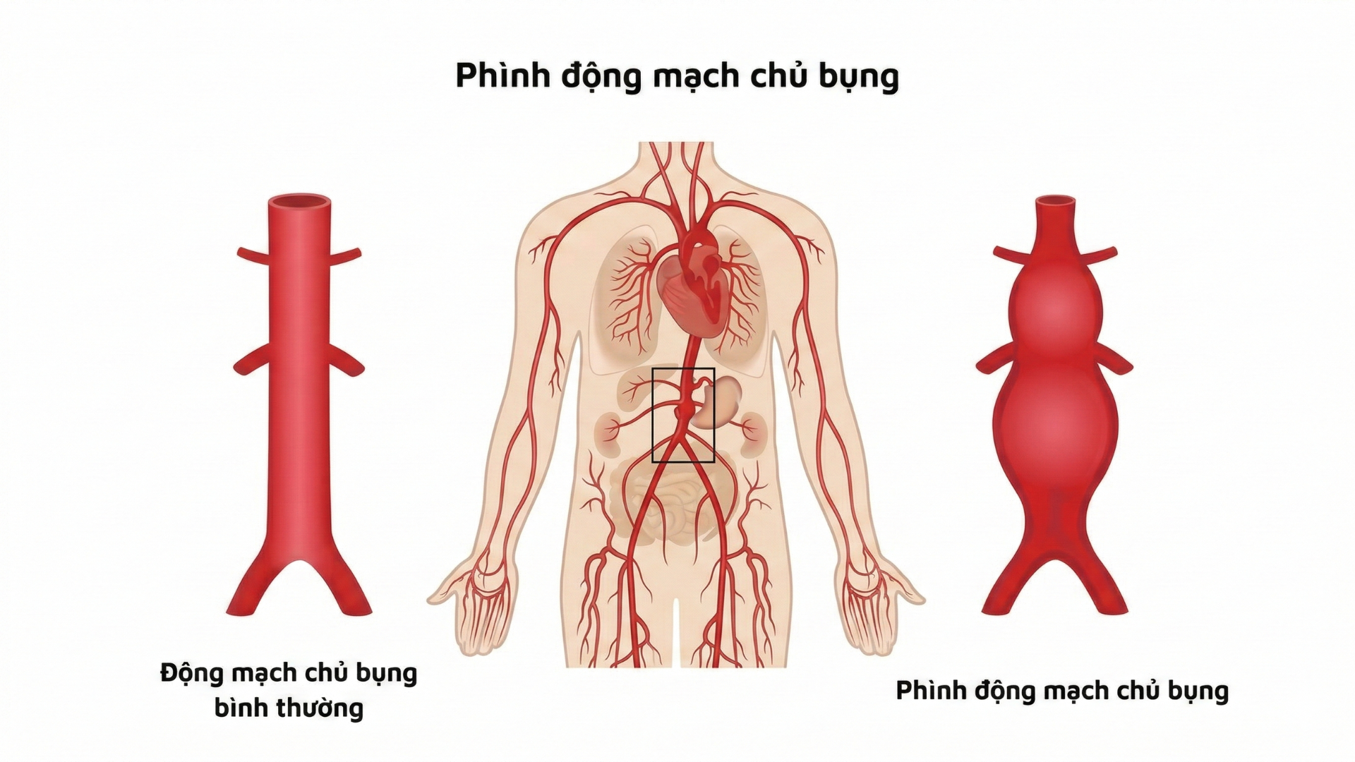 Túi phình động mạch chủ bụng lớn dần có thể tạo cảm giác khối đập theo nhịp tim ở bụng