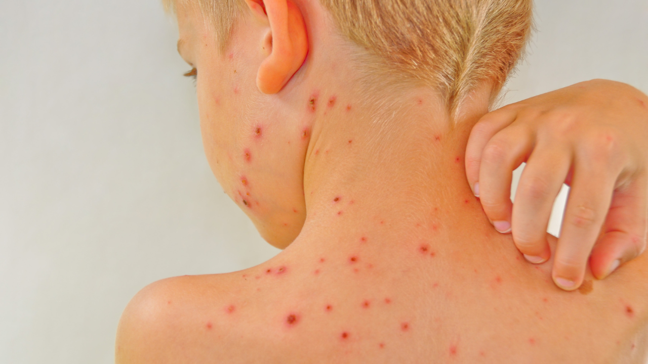 Ở giai đoạn toàn phát, các nốt ban đỏ li ti bắt đầu xuất hiện