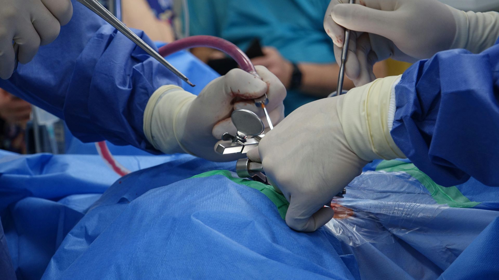 Thoái hóa cột sống gây chèn ép thường được chỉ định phẫu thuật