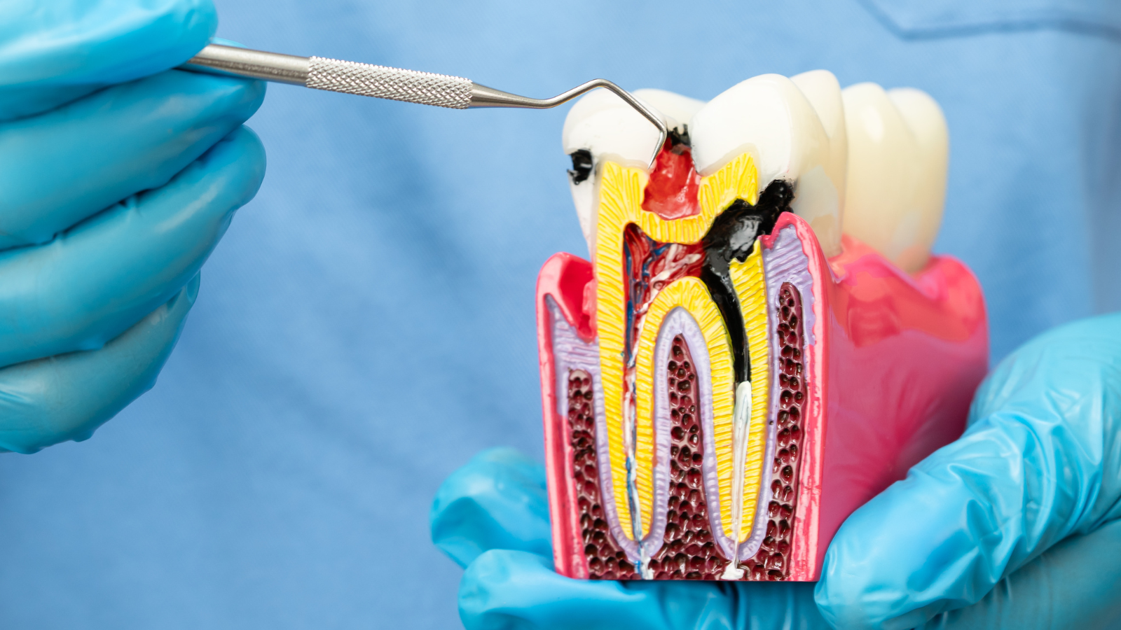 Phương pháp lấy tủy răng là gì?